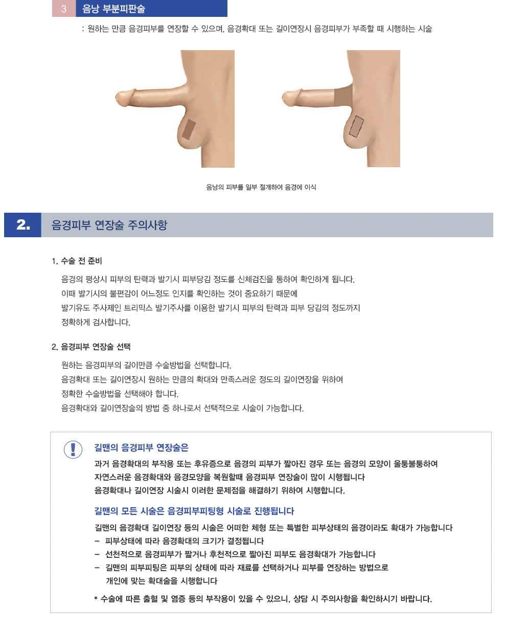 음경피부 연장술